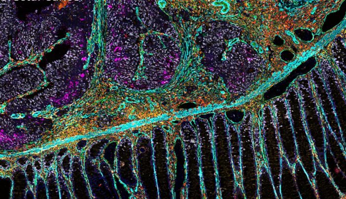 Tumor Ecosystems, Immunometabolism, and the Molecular Origins of Therapeutic Resistance